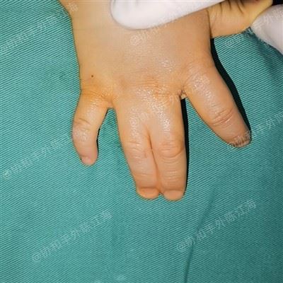 Umělá dermální indukce pro operaci syndaktylie bez štěpu